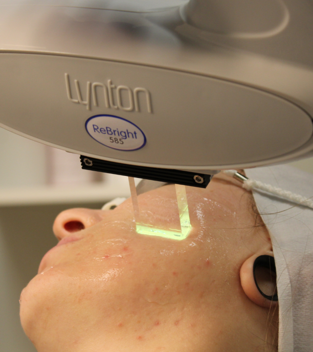 lynton ipl laser treatment
