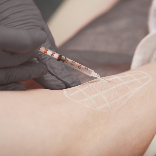 Excessive Sweating Treatment