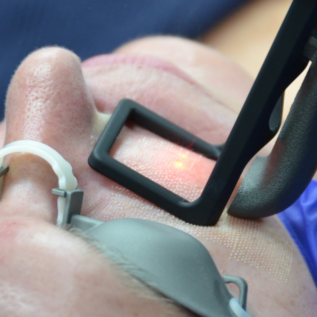 CO2 Laser Resurfacing