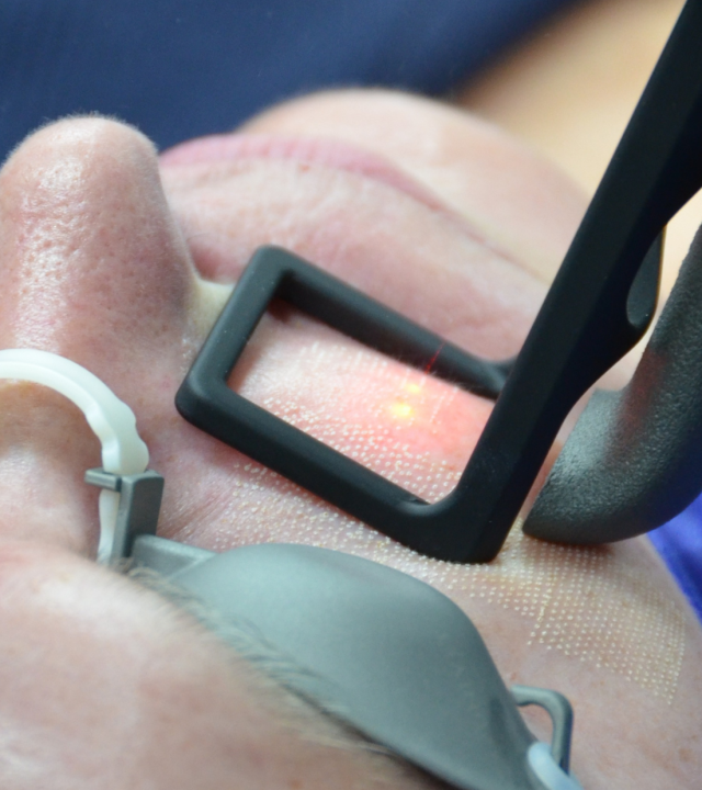 co2 laser resurfacing treatment on face