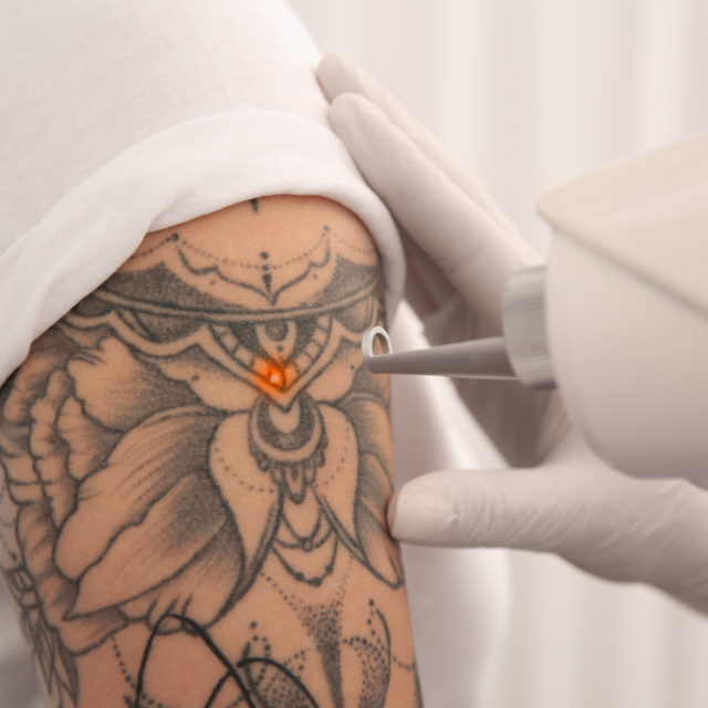 Laser Tattoo Removal
