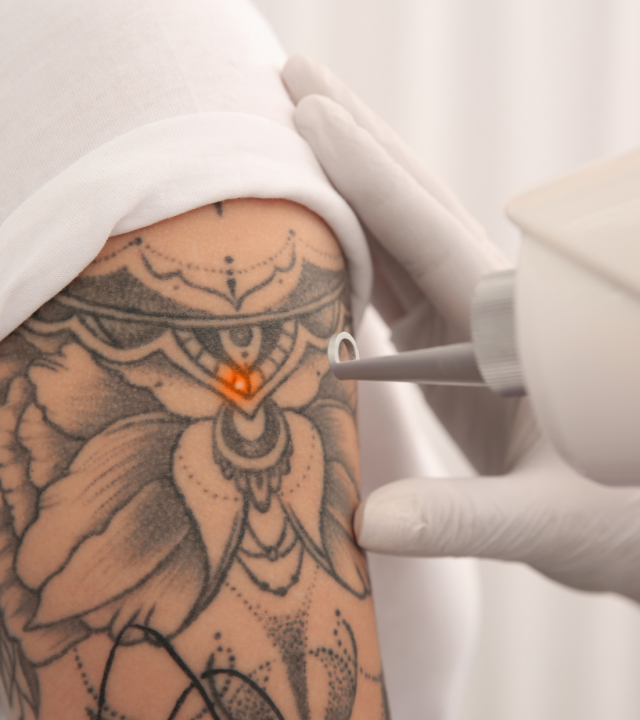 laser tattoo removal treatment on arm