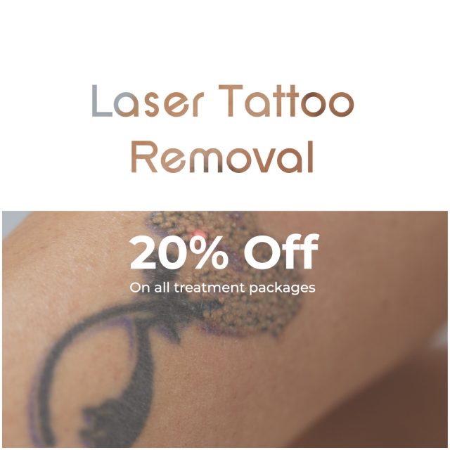 laser tattoo removal 20 percent off