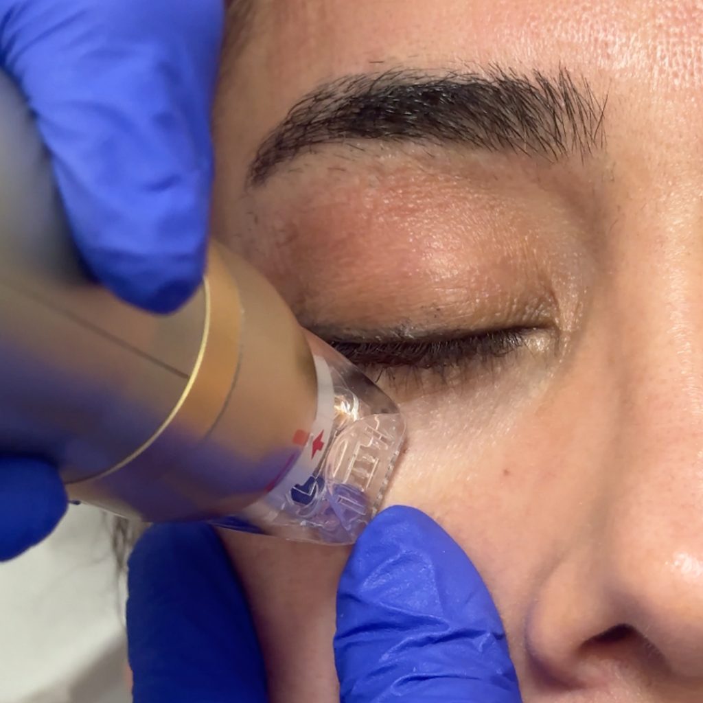 Can SylfirmX Melt the Fat on Your Face?