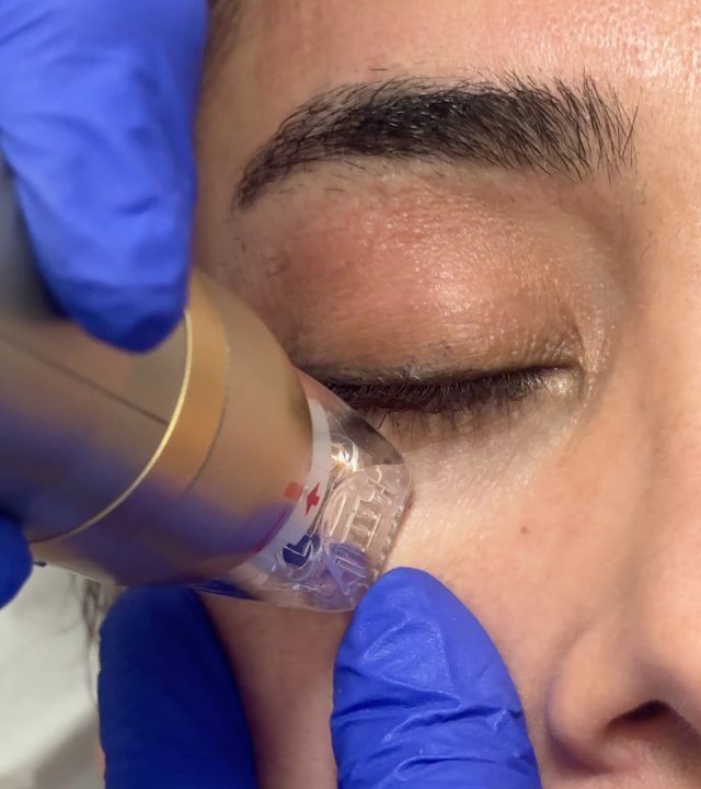 Can SylfirmX Melt the Fat on Your Face?