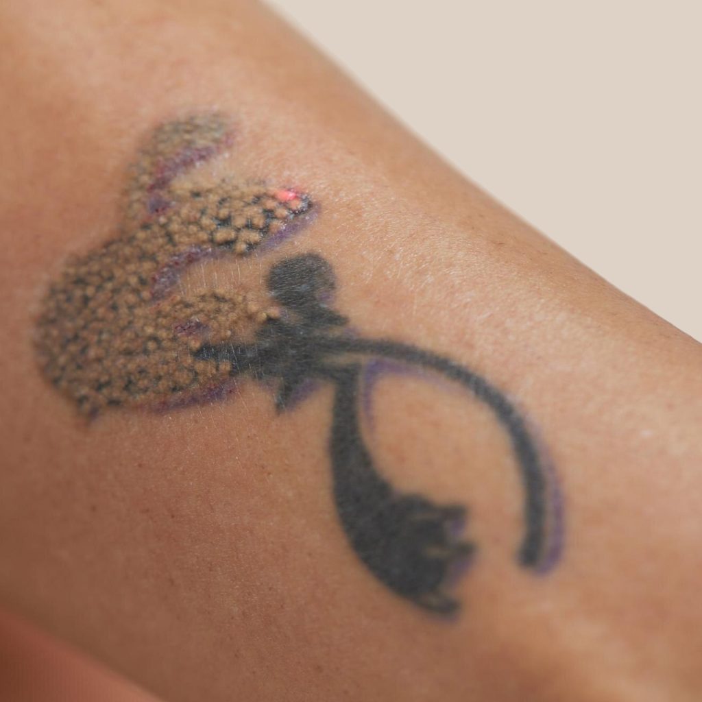 Why Does Tattoo Ink Break Apart Under a Laser?
