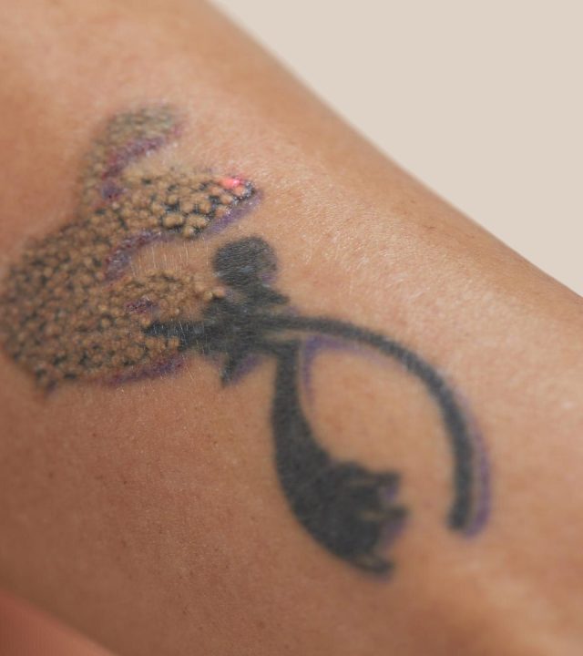 Why Does Tattoo Ink Break Apart Under a Laser?