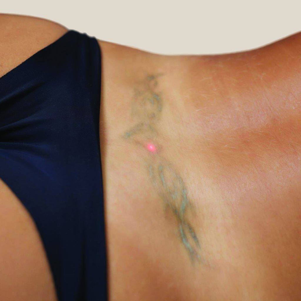 Can Laser Tattoo Removal Scar My Skin?