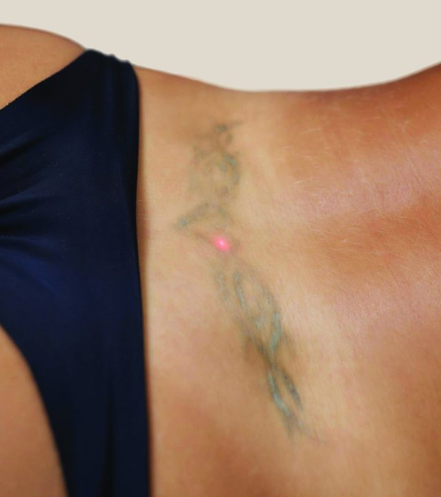Can Laser Tattoo Removal Scar My Skin?