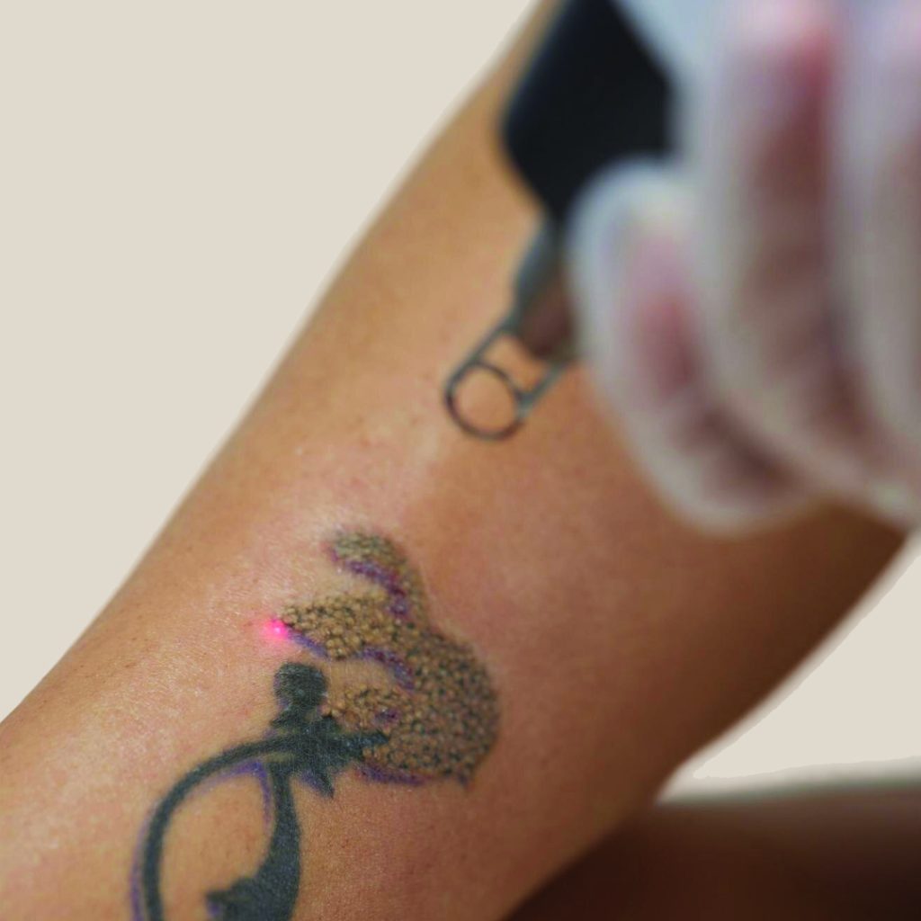 How Many Months Does Tattoo Removal Take from Start to Finish?