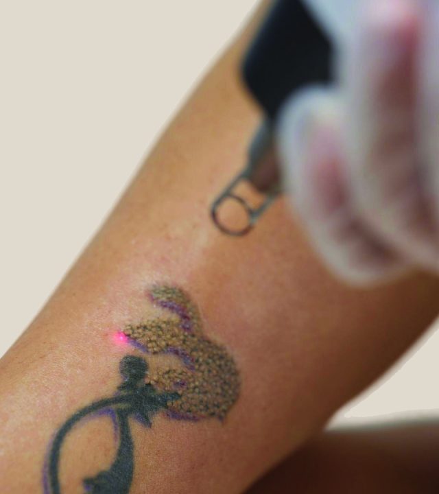 How Many Months Does Tattoo Removal Take from Start to Finish?