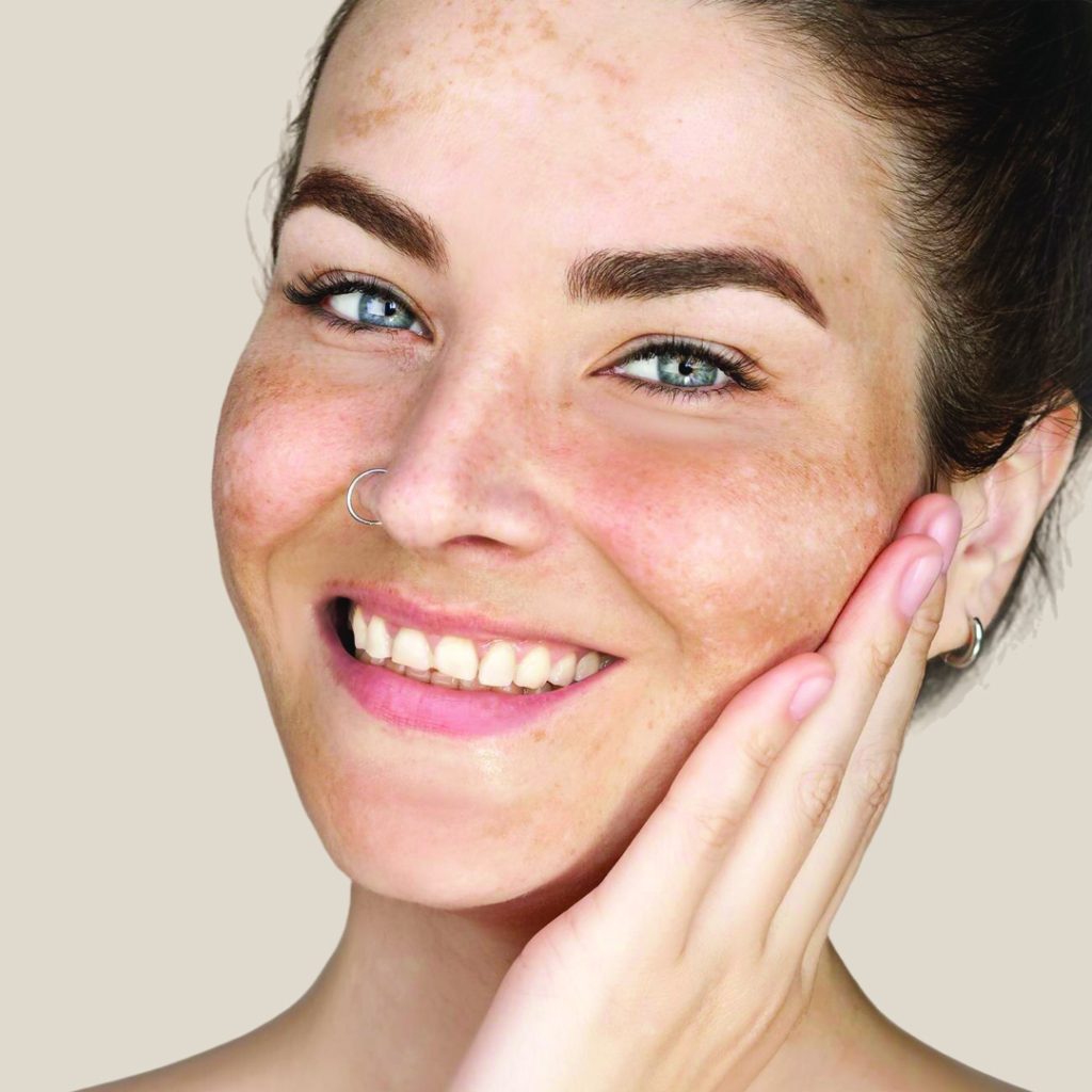 Is Pigmentation Caused by Hormones or Sun?