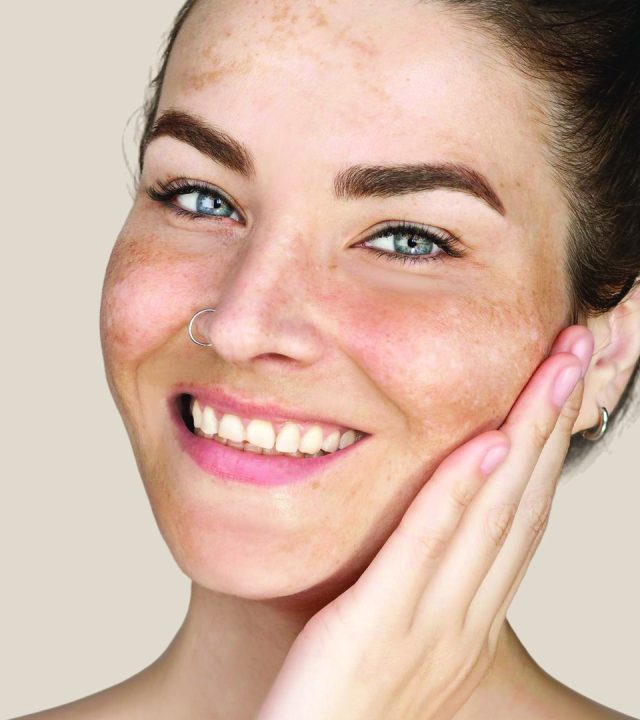 Is Pigmentation Caused by Hormones or Sun?