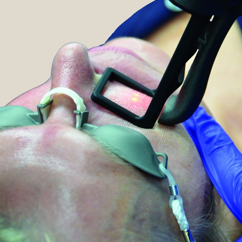 What Does CO2 Laser Do to the Skin?