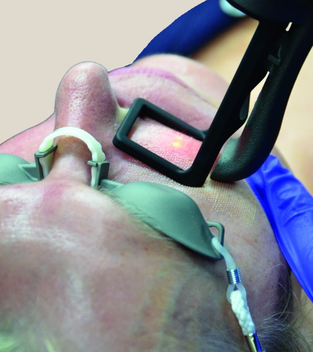 What Does CO2 Laser Do to the Skin?