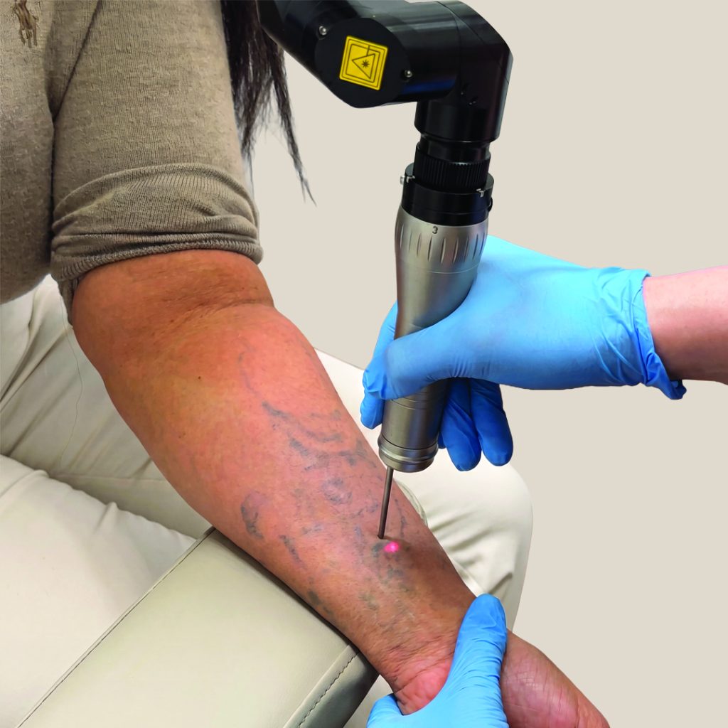 Can I Go in the Sun After Tattoo Removal?