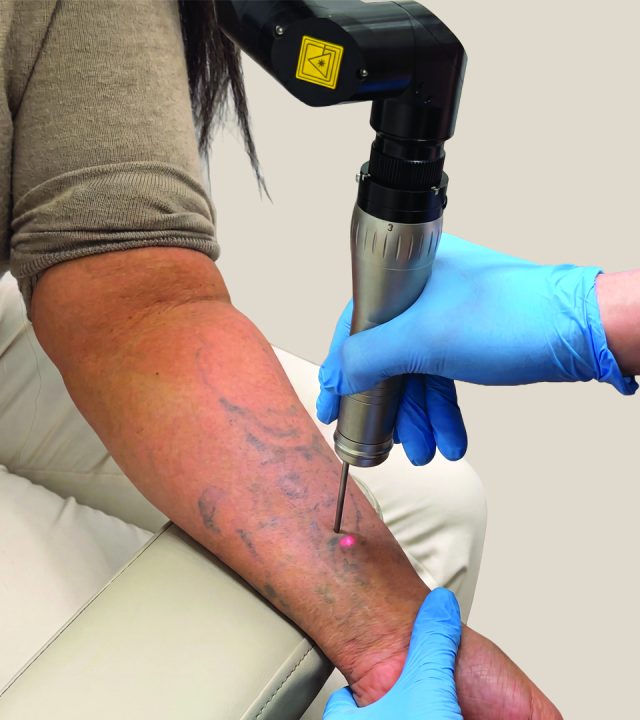 Can I Go in the Sun After Tattoo Removal?